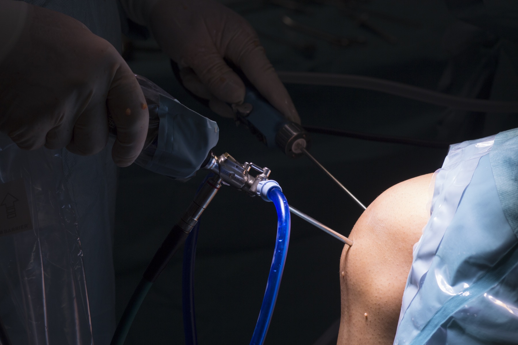 Minimally invasive arthroscopic knee surgery in progress